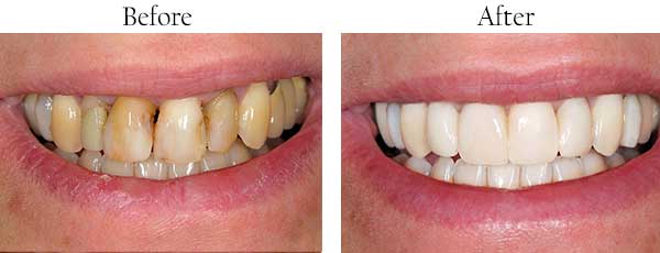Ocean Springs Before and After Invisalign
