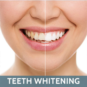 town1 Teeth Whitening
